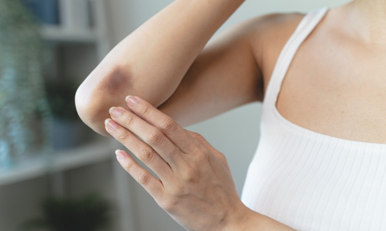 NE OSETITE UDARAC, A MODRICA JE TU? Evo šta vaš organizam pokušava da vam kaže