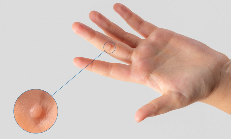 KAKO DA SE REŠITE BRADAVICA Prirodni trikovi koji pomažu bez bola i sečenja