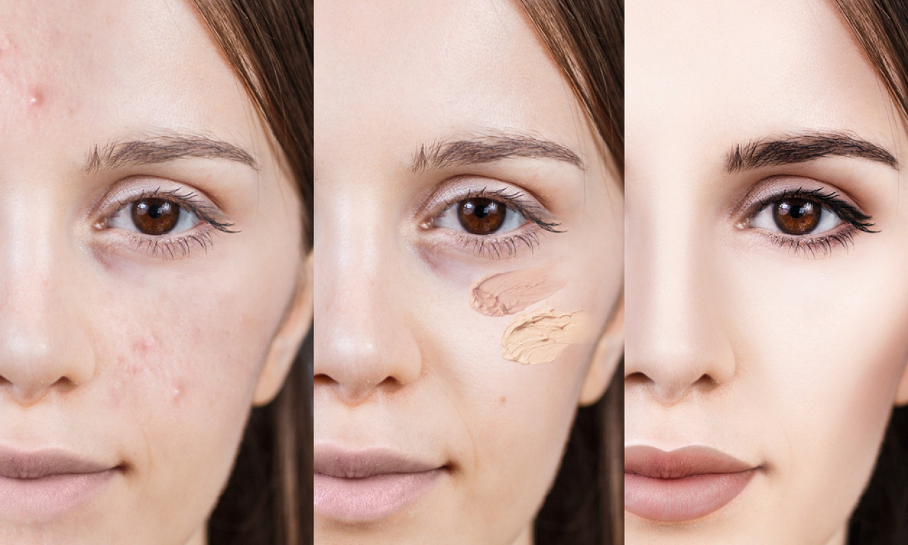 PUDERI KOJE MOŽETE KORISTITI AKO IMATE AKNE Donosimo listu pažljivo odabranih predloga (CENE)