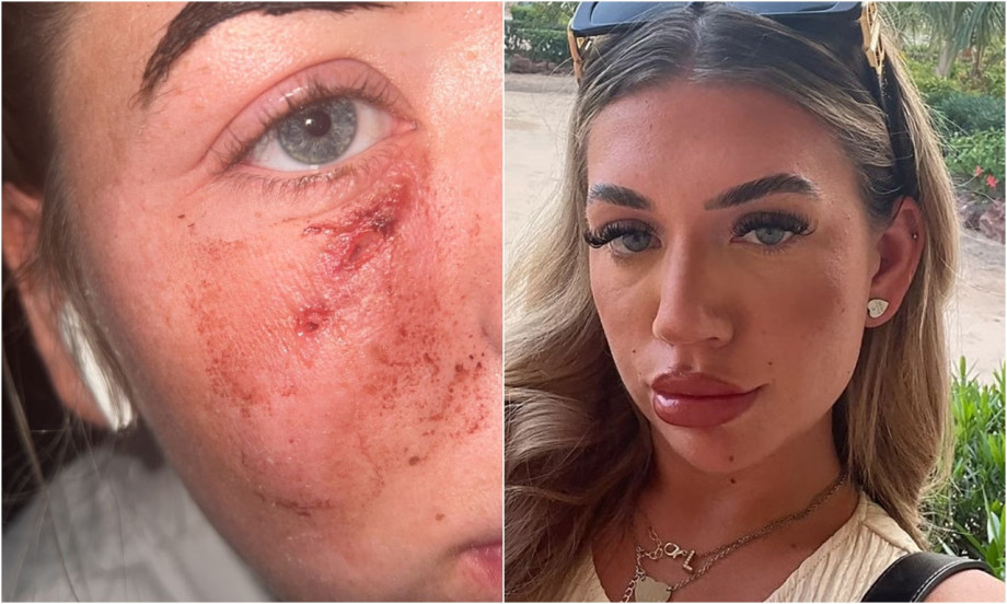 "IMALA SAM OSEĆAJ DA ĆE MI LICE EKSPLODIRATI" Ubrizgala filer da se "osveži" a onda je nastao pakao