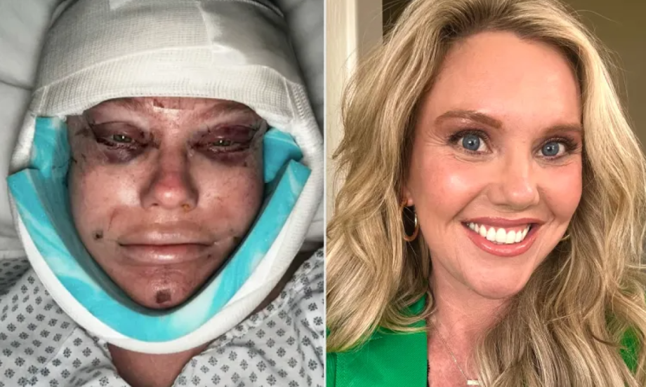 PLASTIČNA OPERACIJA KOJA JE ŠOKIRALA TIKTOK: “Šta sam to uradila?!” – žena (45) pokazala surovu realnost zatezanja lica