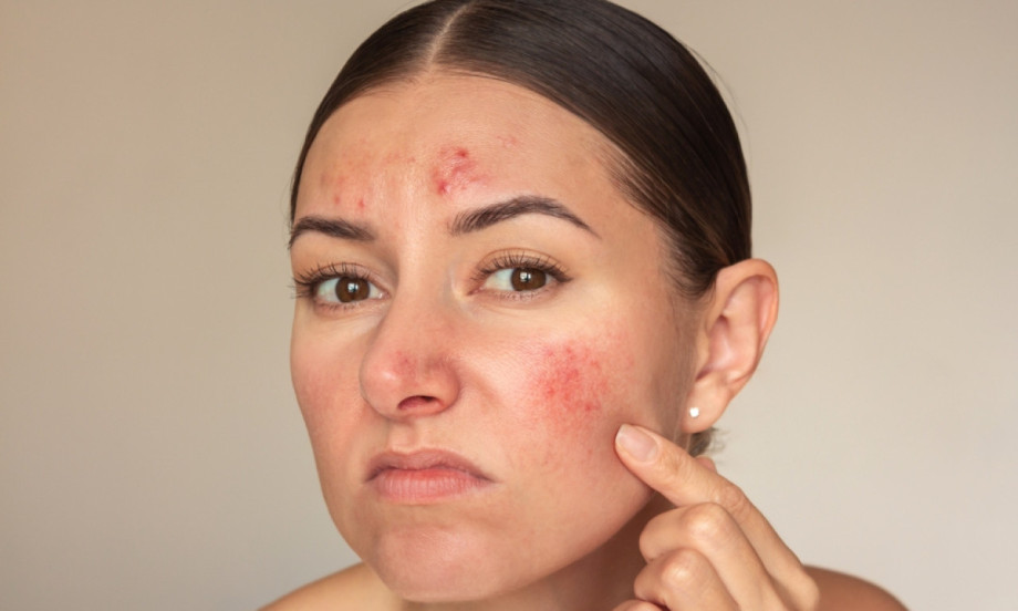 IMATE EKCEM, A VOLITE ŠMINKU? Evo kako da je nosite bez iritacija i pogoršanja kože