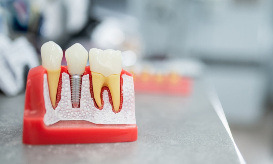 DA LI SU DENTALNI IMPLANTI BEZBEDNI? Evo šta kažu stručnjaci i najnovija istraživanja