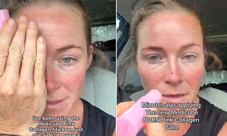"FILER BEZ IGLE" JE HIT NA TIKTOKU Dermatolozi otkrili da li zaista radi (VIDEO)